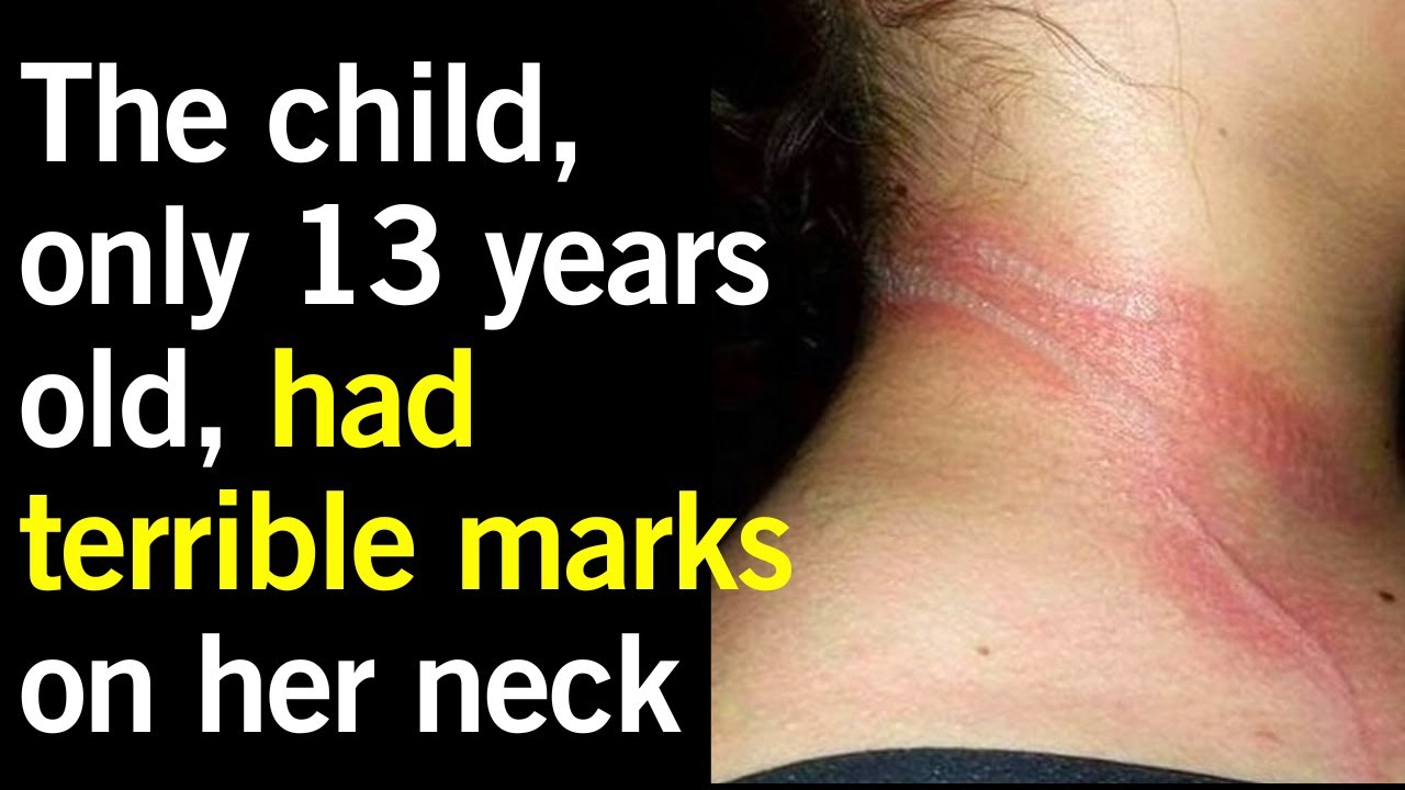 The child, only 13 years old, had terrible marks on her neck